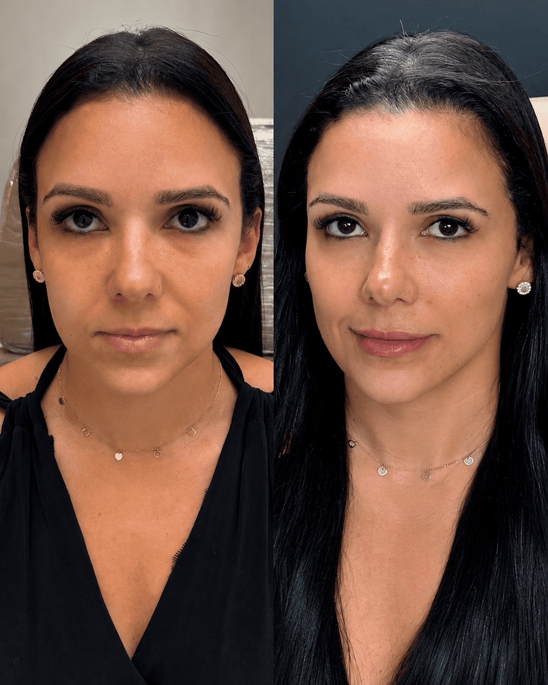 Antes e depois de preenchimento facial realizado pela Dra. Jeane Barbosa