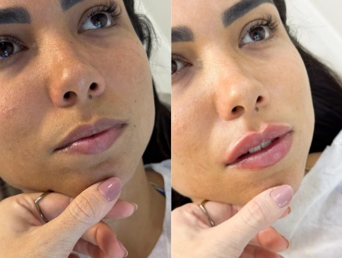 Antes e depois de preenchimento labial realizado pela Dra. Jeane Barbosa
