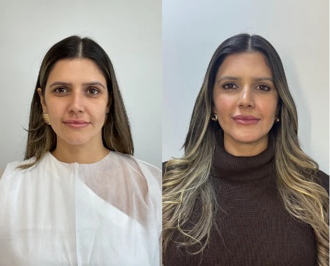 Antes e depois do Protocolo de Rejuvenescimento facial realizado pela Dra. Jeane Barbosa