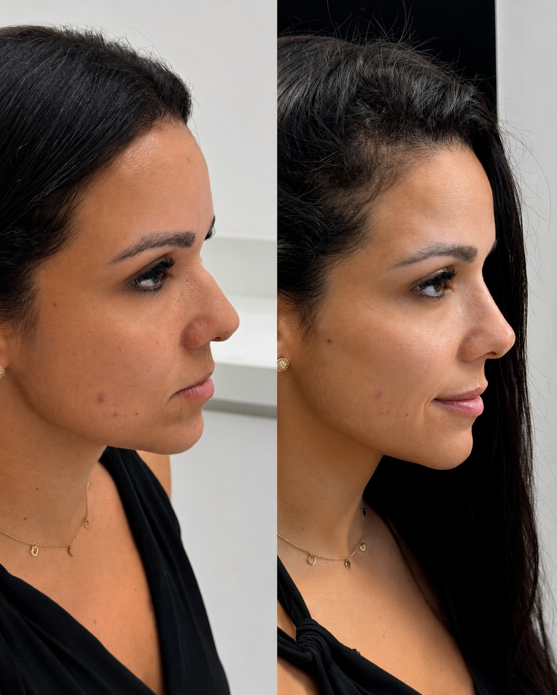 Antes e depois de rinomodelação realizada pela Dra. Jeane Barbosa