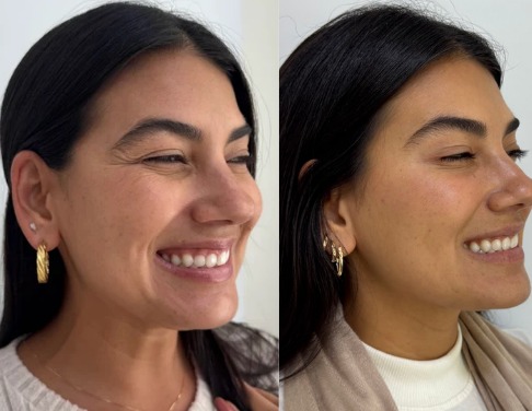 Antes e depois de aplicação de toxina botulínica realizada pela Dra. Jeane Barbosa